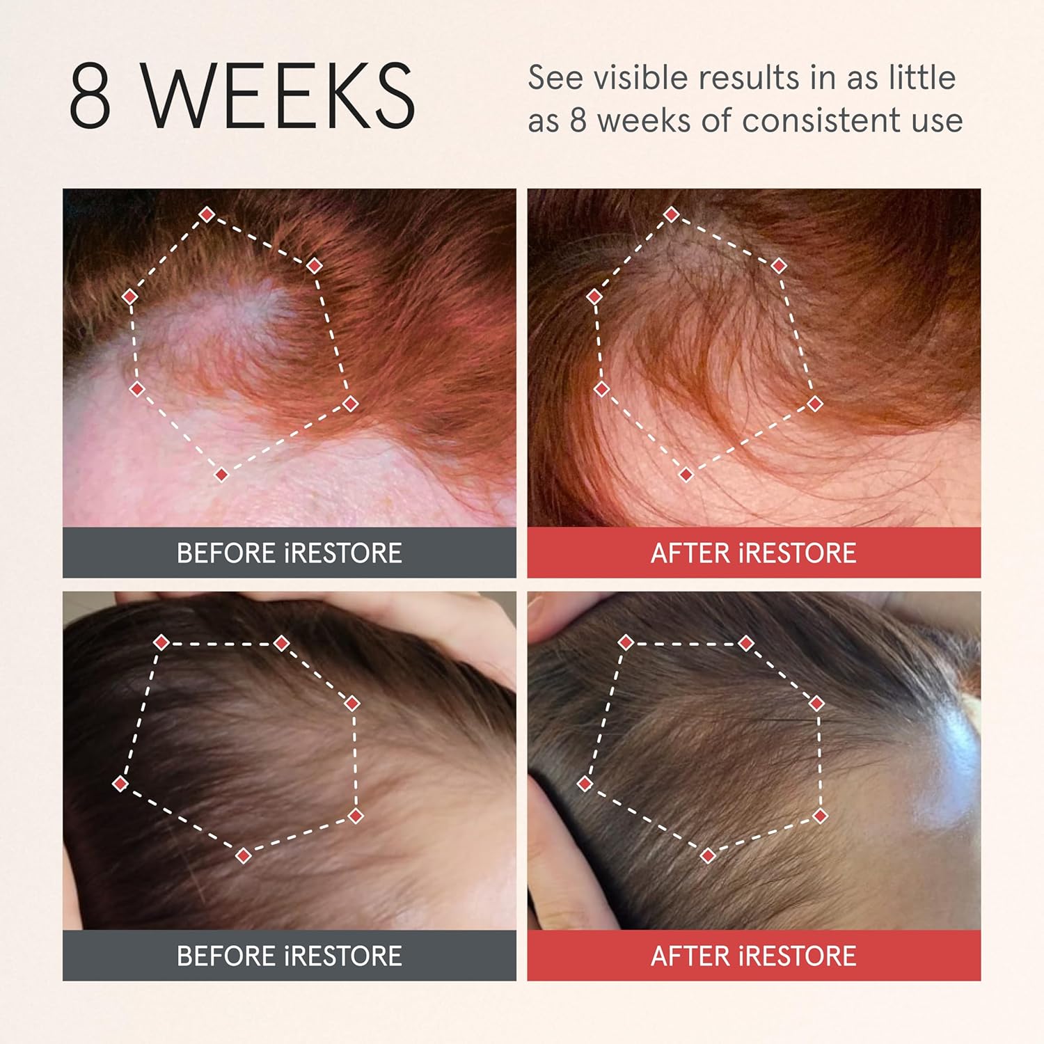 iRESTORE Scalp Serum Hair Growth Serum for Women Men Best for Hair Loss Hair Thinning Aids Regrowth with Redensyl Biotin Hydrates Scalp for Visibly Thicker Stronger Hair 2 Fl Oz Pack of 3 - Image 2