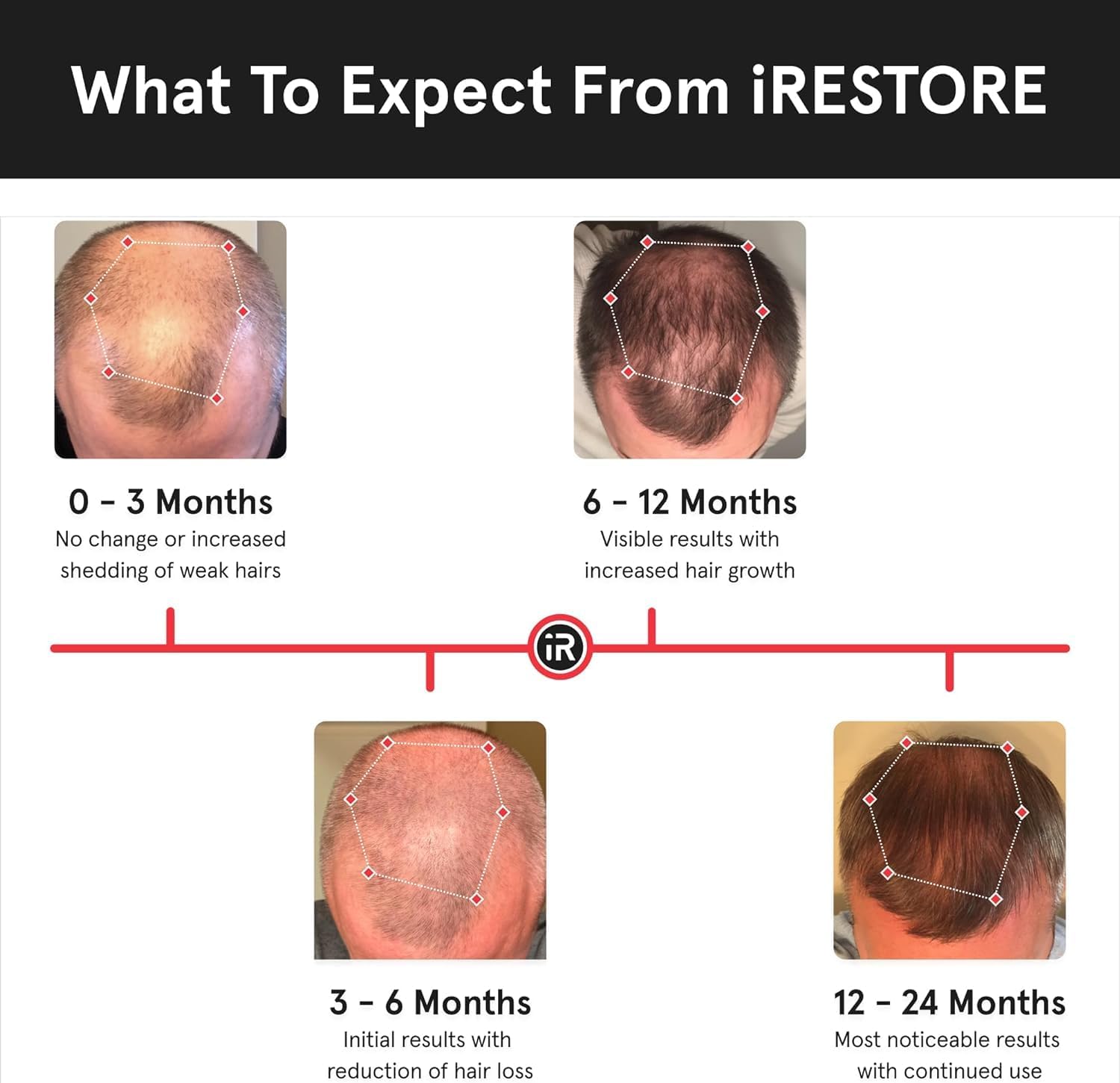 iRestore Professional FDA Cleared Laser Hair Growth Device Red Light Therapy for Thinning Hair Receding Hairline Balding Laser Cap for Men Women DrugFree Hair Loss Treatment - Image 5